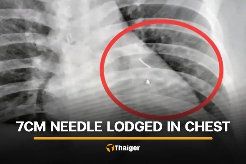 7-centimetre needle found near heart of Buriram man